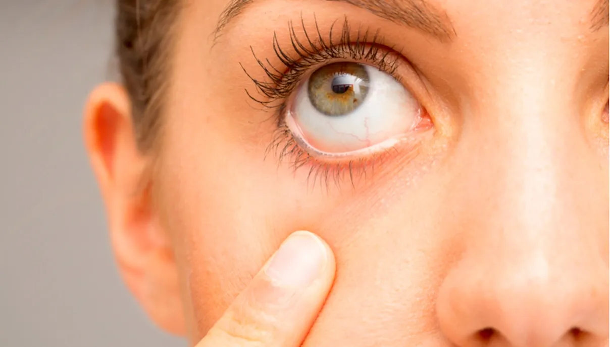 Primo piano di un occhio aperto con la palpebra inferiore abbassata con un dito, durante un controllo oculare per valutare lo stato della superficie e del film lacrimale.