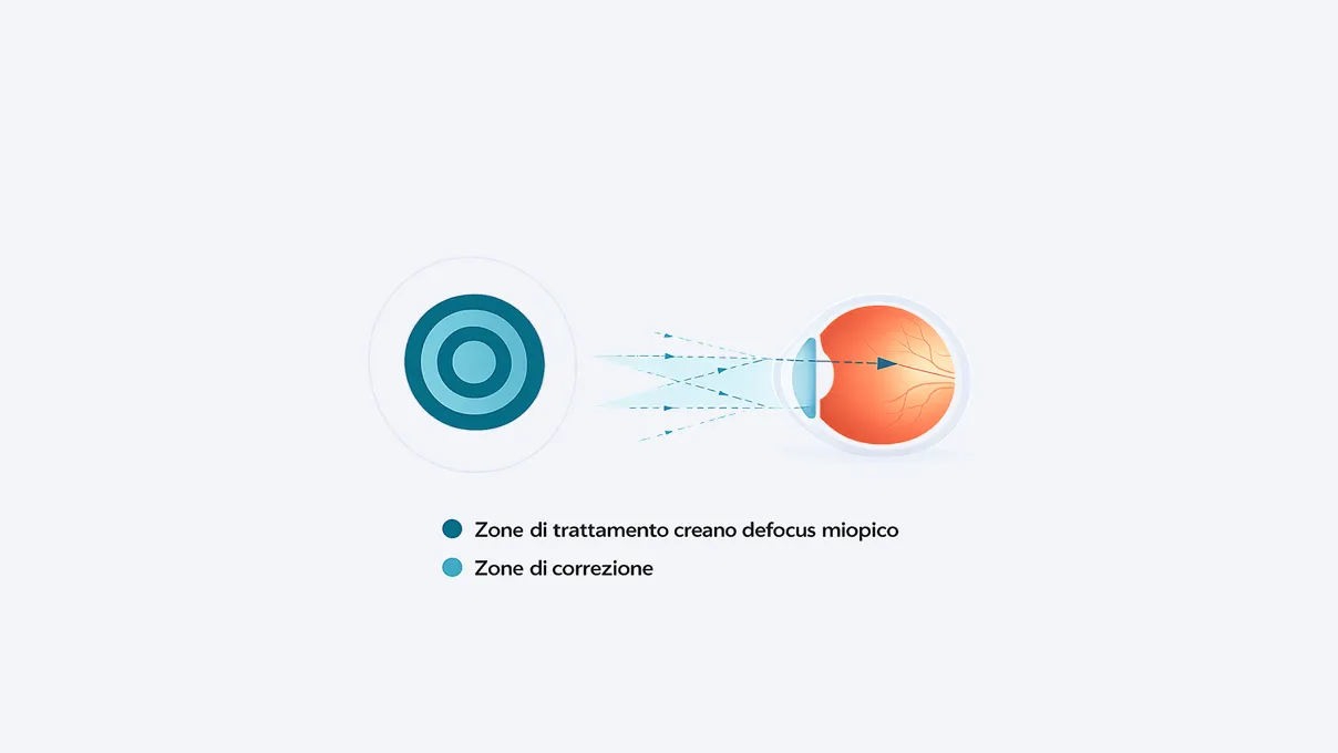 Schema della lente a contatto MiSight® 1 day: gli anelli concentrici di trattamento ActivControl® attorno alla zona di correzione centrale.