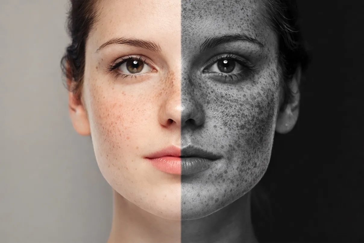 Foto di una ragazza dove si evidenziano gli effetti dei raggi UV sul suo viso