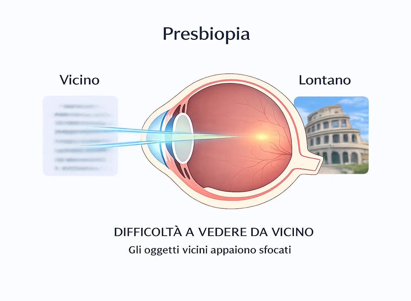 Rappresentazione della presbiopia: ridotta capacità del cristallino di mettere a fuoco oggetti vicini con l’età.