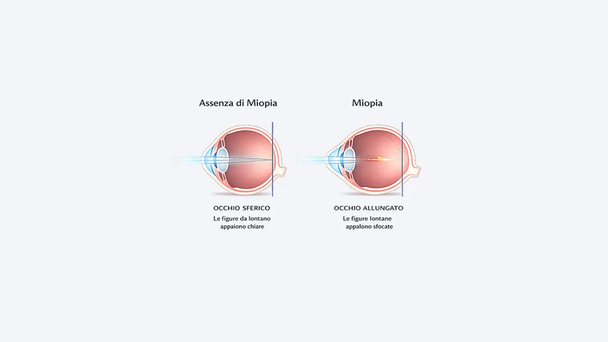 Confronto tra occhio sano e occhio miope con differenza nel punto di messa a fuoco